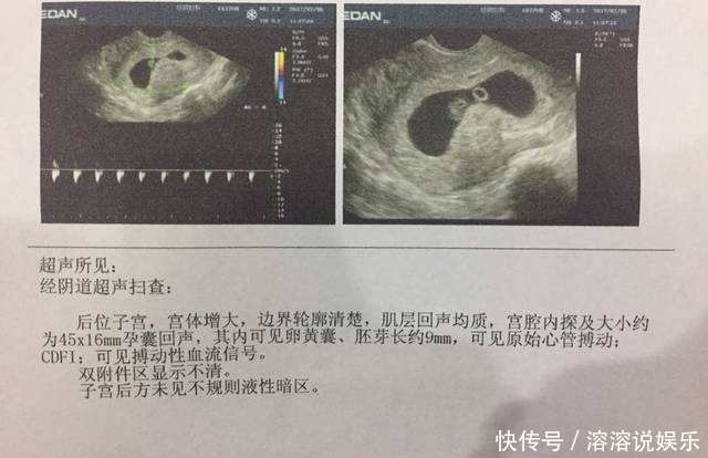 胎心|做B超时别再问医生胎宝宝性别了，是男是女，自己看单子也能分辨