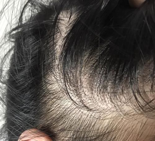 肥胖者|21岁女大学生脱发,惨遭谢顶,提醒:一种水少喝,不然早晚要光头