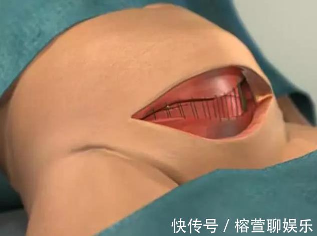 羊水|剖腹产仅划一刀就了事太天真!先看看用的器具,就知道女人多牛