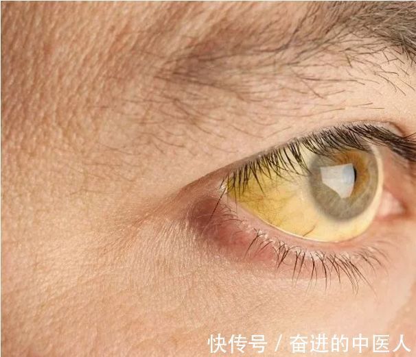 春天|成都中医肿瘤医院:名老中医谈诊治肝肿瘤引起的黄疸