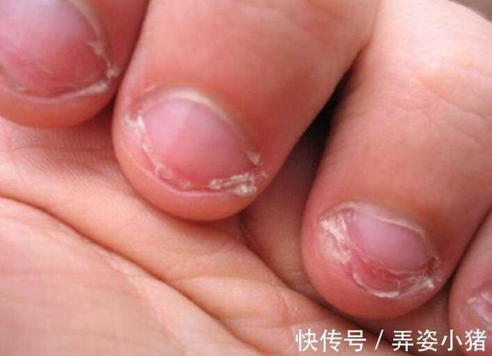 宝妈|小时候喜欢“啃指甲”的孩子,长大后会怎样无法避开这几种结局