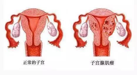 子宫腺肌症|“痛经”的背后可能藏着这个可怕的疾病