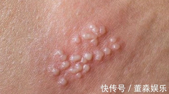 分泌物|带状疱疹又叫“龙缠腰”,痛起来要命,3个妙招帮你轻松解决