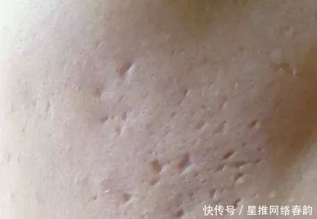 炎症|应该先去以前的旧痘印,还是先去新长出来的痘痘?