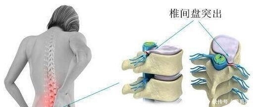 “灭掉”腰椎间盘突出，仅需1个保守疗法，不花一分钱，神奇
