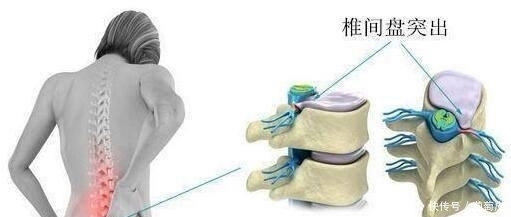 “灭掉”腰椎间盘突出,仅需1个保守疗法,不花一分钱,神奇