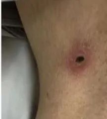 恙虫病|小心这种虫子！市民被咬后生命垂危，住进ICU