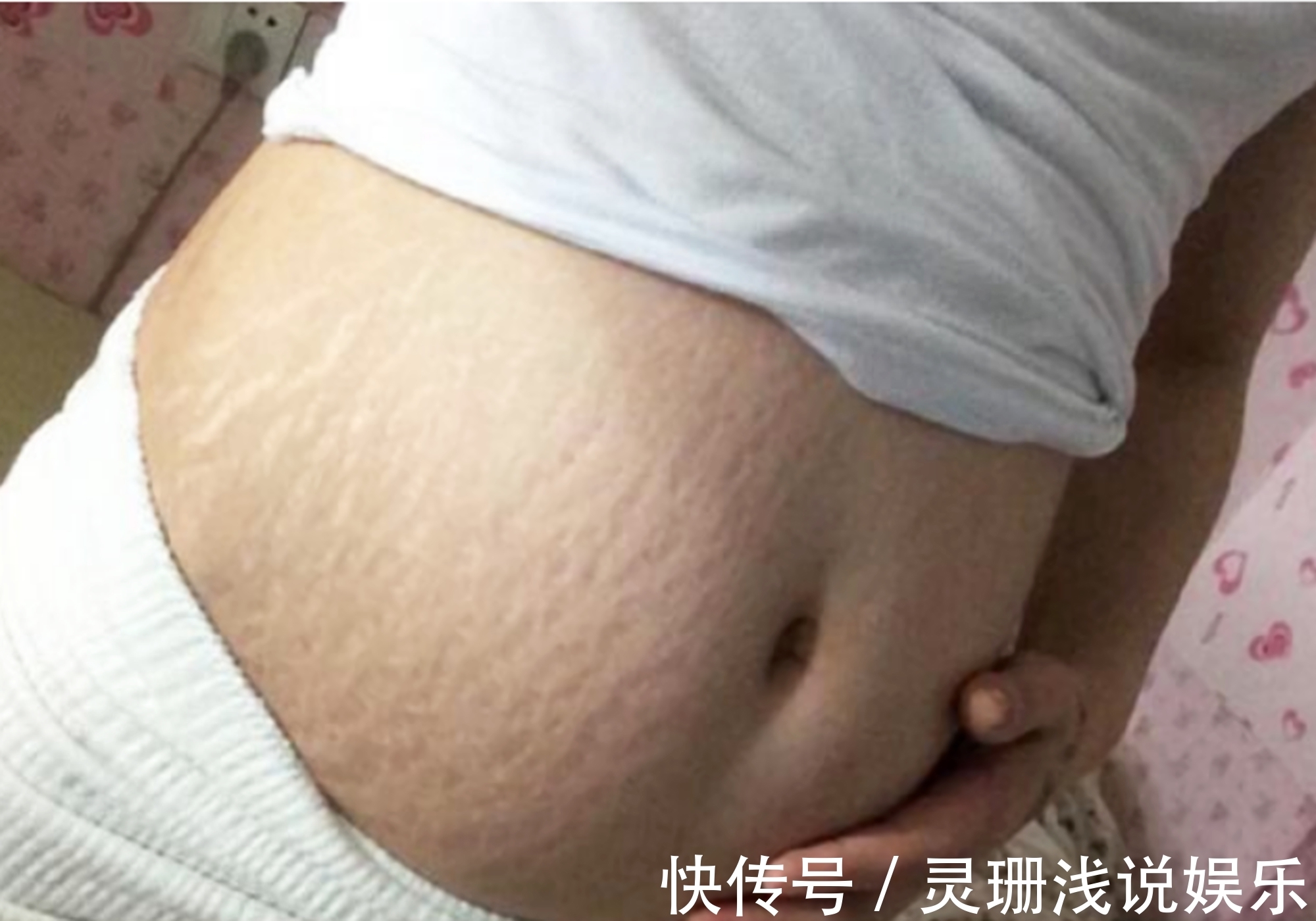 妊娠纹|孕期妊娠纹也挑人,4类孕妈躲得开,如果你全都符合,真让人羡慕
