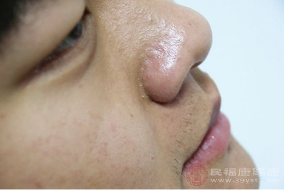 臉長老人斑怎么處理好