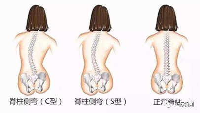 孩子|孩子背部突出没在意，结果拖到要动手术