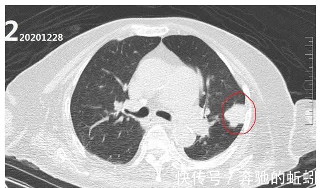 ct|如果不治疗的话，肺癌的发展速度到底有多快？