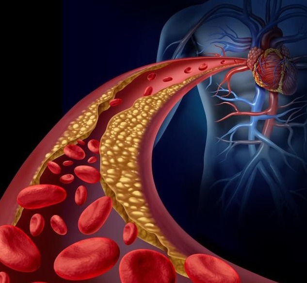 胆固醇|高血脂是吃出来的坚持“两低一高”饮食,2个月轻松吃掉高血脂