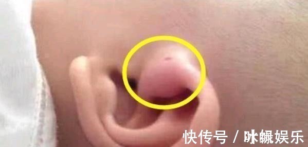 分泌物|儿子的耳朵上有个小洞宝妈试图挤压,导致孩子昏迷,被送到医院