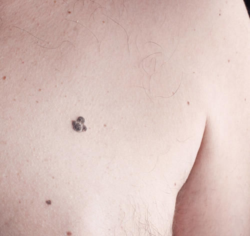 恶变|黑色素瘤和痣傻傻分不清?教你从5个方面来辨别,要及时处理