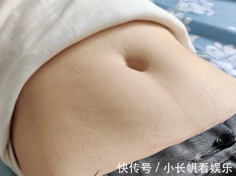 孕期|生个孩子“肚皮开花”,孕期做好掌握这3点,妊娠纹离你远远的