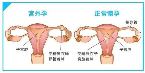 宫外孕手术后多久能上班