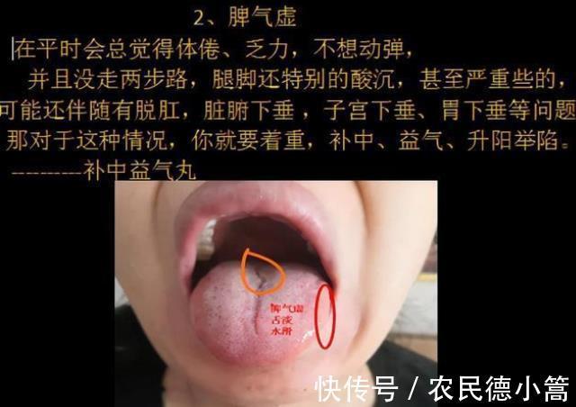 久病|气虚到底应该怎么补?中医师:分清这“4种”气虚,快速补气