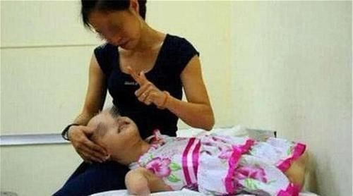 产检发现宝宝“缺少四肢”,宝妈却坚持要生,如今孩子活成小公主