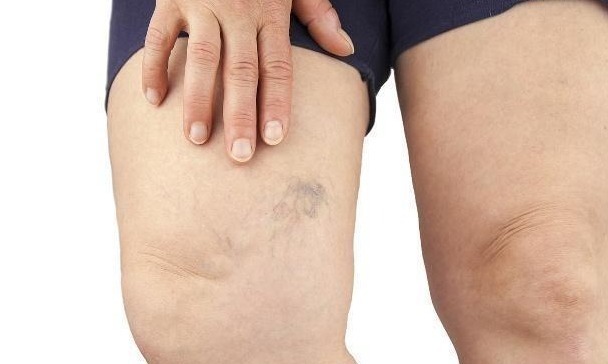 血糖|身患“糖尿病”的人,表现都很明显,为健康别再傻傻忽视