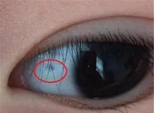 眼白处|3岁女儿眼睛出现“多个黑点”,原因竟是奶奶买的“哄娃神器”