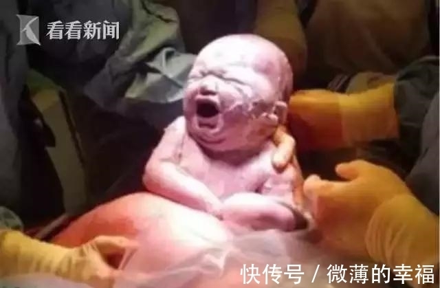 女子|女子剖腹产子,医生从肚子里取出一个肉球!网友:这是哪吒啊