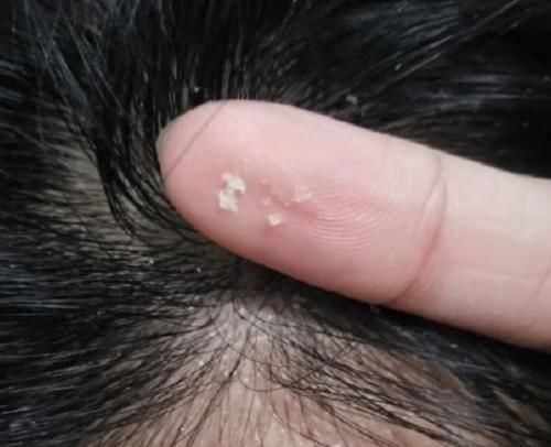 头上抠出白色“颗粒物”?到底是什么?通常离不开“3个原因”!