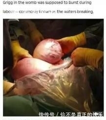 柔伊|医生从妈妈肚子里取出一个肉球!网友:这是哪吒啊