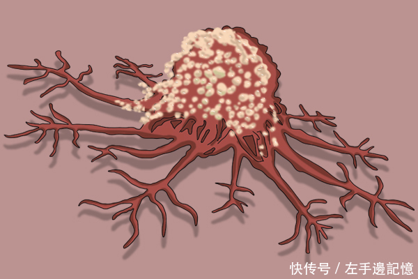医生提醒大家,得了癌症,皮肤是会给出信号的,4点异常较为明显