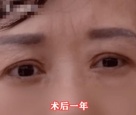 手术|女子花2万元割双眼皮失败，老公看后要闹离婚，女子：大家来评评理