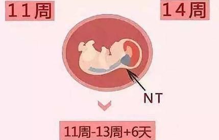 唐氏筛查|第一次胎儿排畸做什么关于NT筛查,孕妇一定要懂
