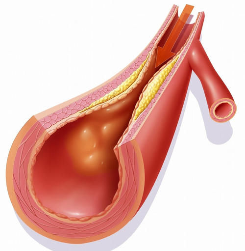  利血平|“0号”降压药，减慢心率、扩张血管、利尿降压，但要注意胃出血和抑郁
