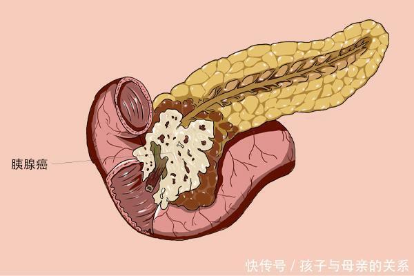 留意到|癌症不是突然就发生,早期5个症状,留意到的人并不多