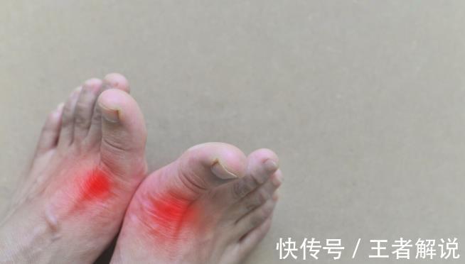 嘌呤|非布司他是降尿酸“利器”，长期吃有副作用吗？医生告诉你实情