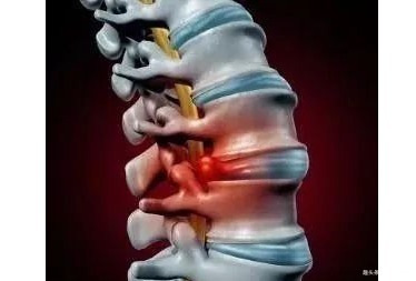 腰突症|一个妙方南瓜+绿豆,腰不疼了,腿不麻了,坐骨神经痛也说拜拜