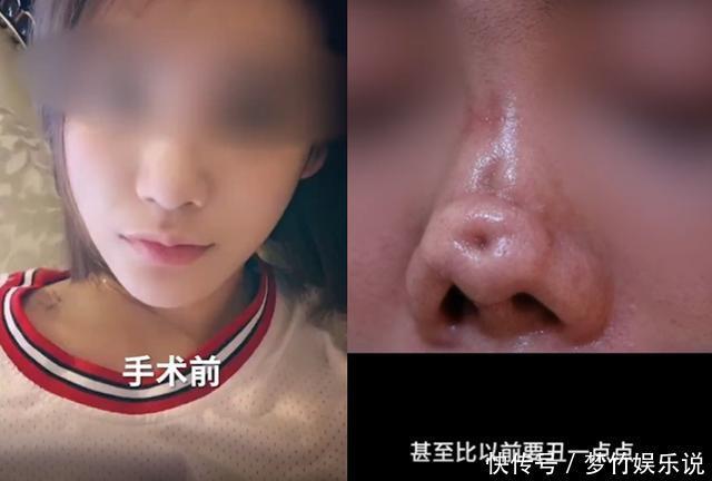 做缩小鼻头整形价格？缩小鼻头手术的价格？
