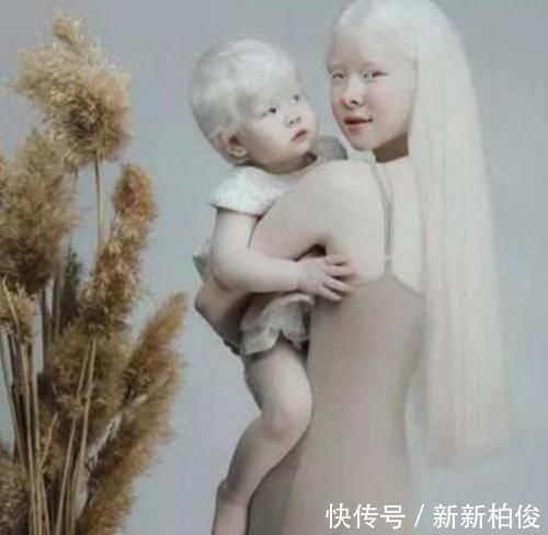 元气满满|“妈妈,我怕光”,姐妹俩出生全身雪白,网友:父母太不负责任