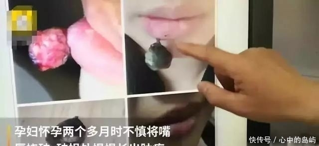 东西|嘴唇干燥不舒服,孕妇挠破了皮,没想到一个月后居然长出个可怕东西