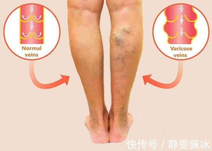 血管|走路的时候出现这3个问题,提示你的血管可能堵了