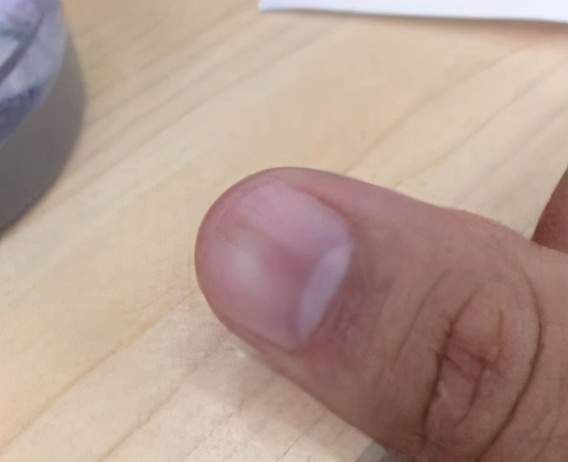 肝脏|肝脏不好的人,会出现2处黑,2处红,一个不占,说明肝比较健康