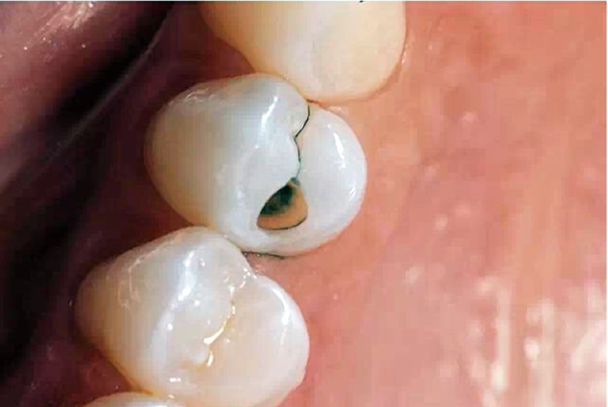 家长|好不容易等到宝宝换牙期,新牙却长歪了医生家长无知惹得锅