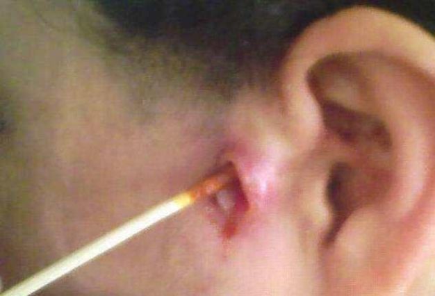 耳朵|孩子耳朵旁边长出“聪明孔”,奶奶好奇挤了一下,不料却惹了麻烦