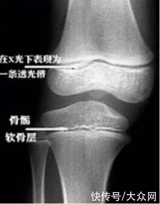 李女士|二十三，蹿一蹿？“成人增高”是智商税