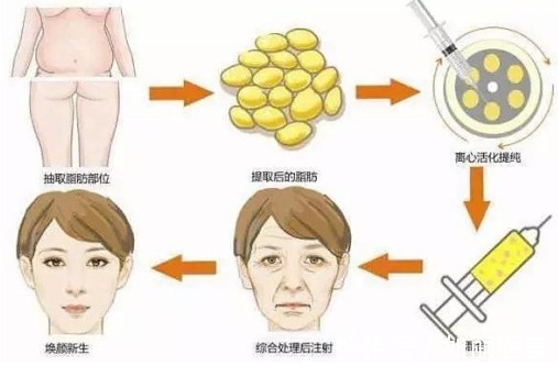 面部 自体脂肪填充面部都有哪些术前术后注意事项?