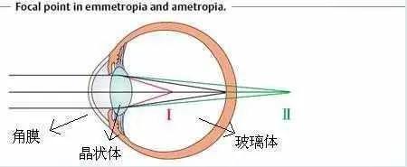 屈光度|让眼屈光发育可控，便是掌握了“近视”终结者