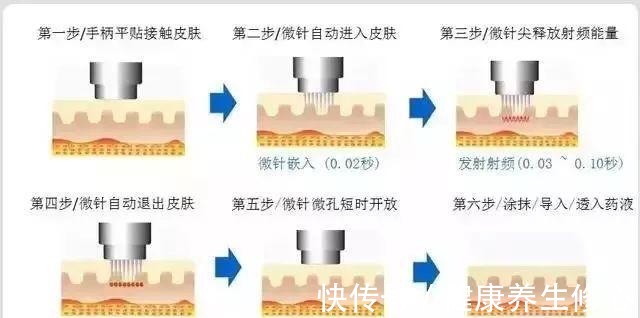 微针 号称“小热玛吉”的黄金微针你了解吗！