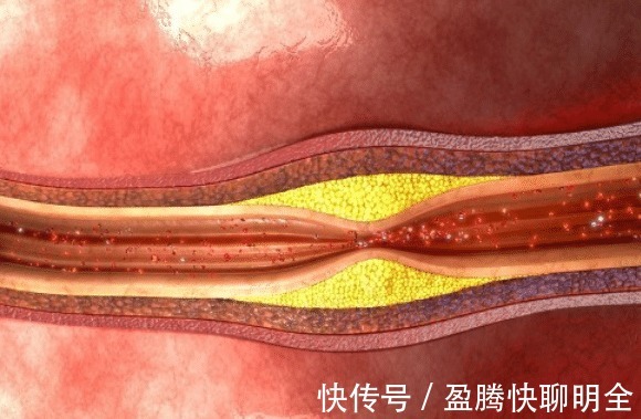 心内科医生|常吃红薯能降血脂？心内科医生：若想血管健康，2种粗粮趁早远离