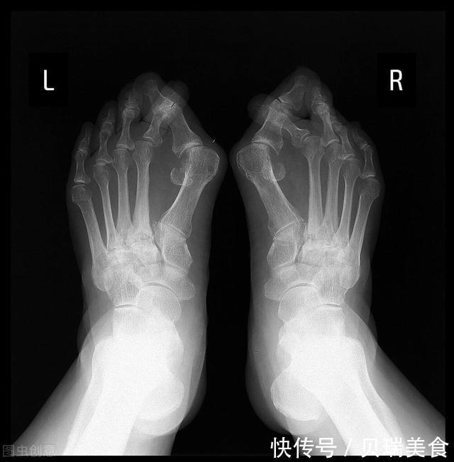 大拇|路医生说丨高跟鞋美女脚下的痛，得了“拇外翻”，该怎么办？