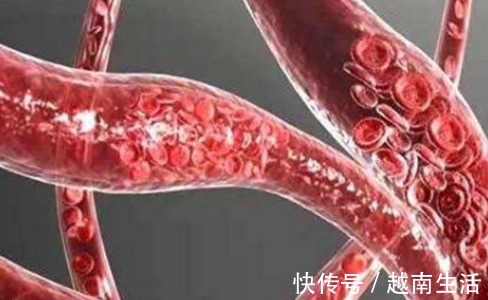 疏通血管|血管堵、血管硬，1个动作，每天拍一拍，疏通血管，冲走血管垃圾