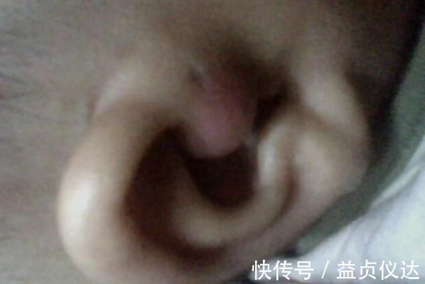 手术|宝宝耳朵上有个洞, 以为是好事, 知道真相, 妈妈懵了