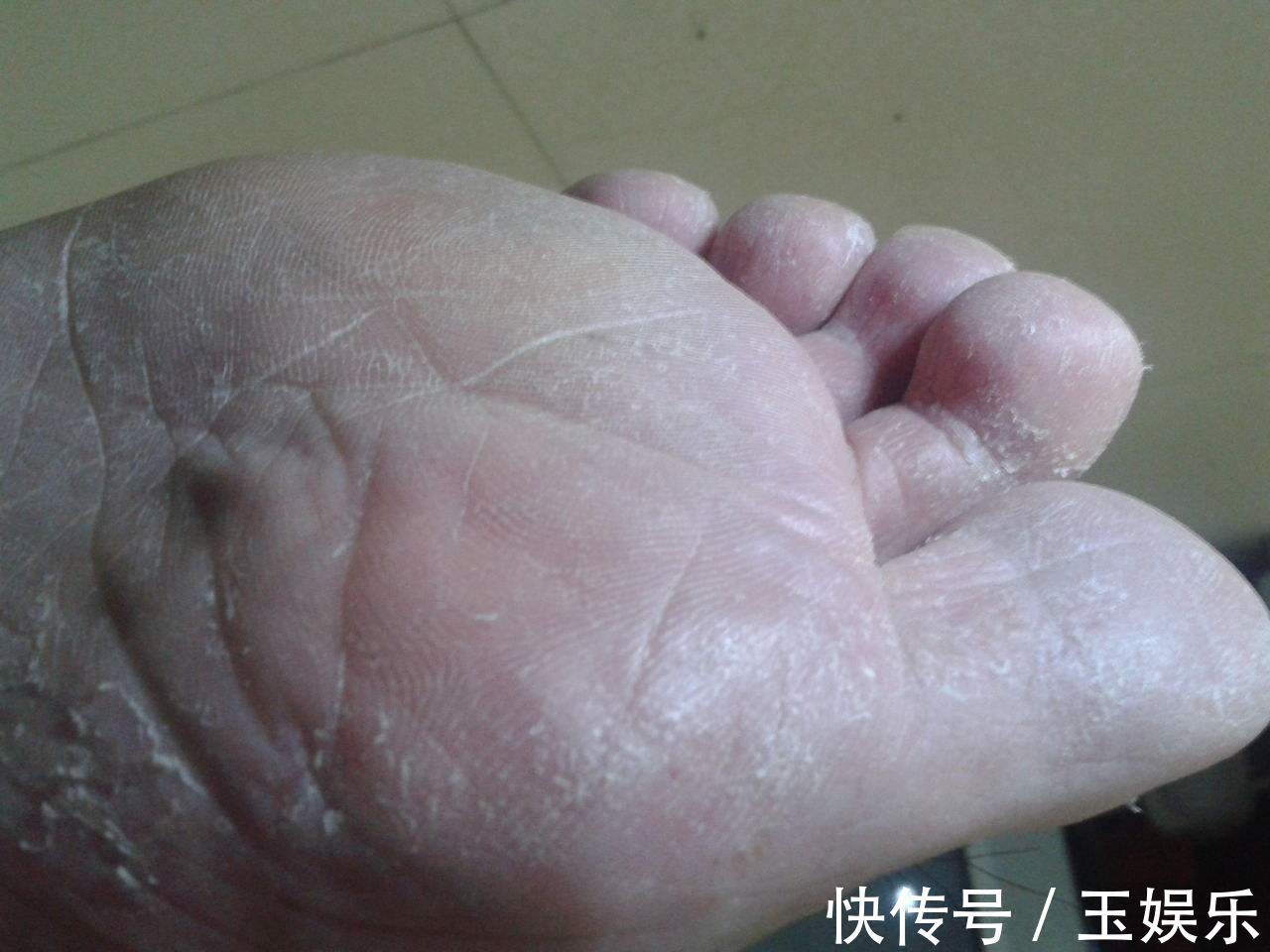 三高|脚出现三大症状就要当心了,可能是糖尿病足来了